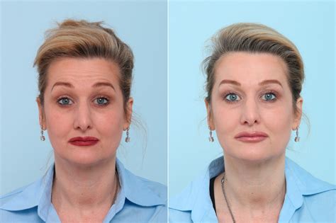 The swelling is greatest 2-3 days <b>after</b> surgery, and may remain for an additional 3 days before it starts to resolve. . First 48 hours after botox